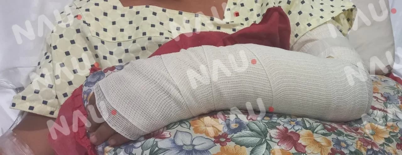 Este miércoles darán de alta a menor mordida por Pitbull en la colonia los Llanes 3