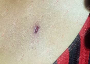 No fue Rayo, fue un balazo que recibió una señora el pasado 23 de junio