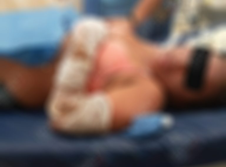 Guatemalteca que sufrió quemaduras sigue internada en el HGT