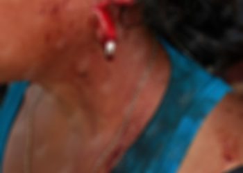 Su esposo le cortó la oreja en la colonia 3 de Marzo