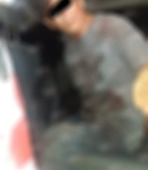 Le amputaron la mano en una riña