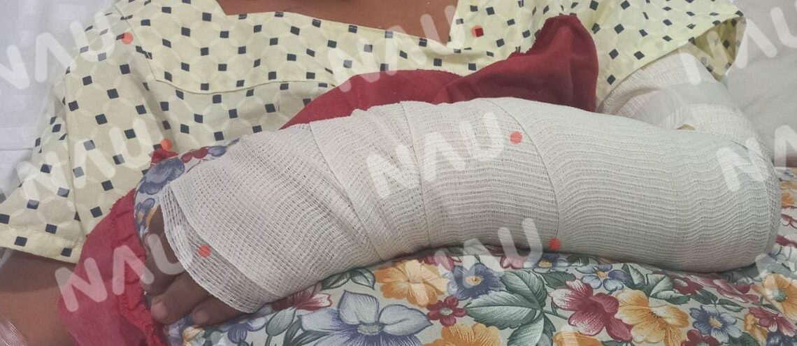 Este miércoles darán de alta a menor mordida por Pitbull en la colonia los Llanes 3