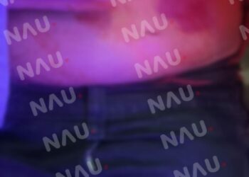 En asalto, hieren a un joven de 17 años en el centro de Tapachula